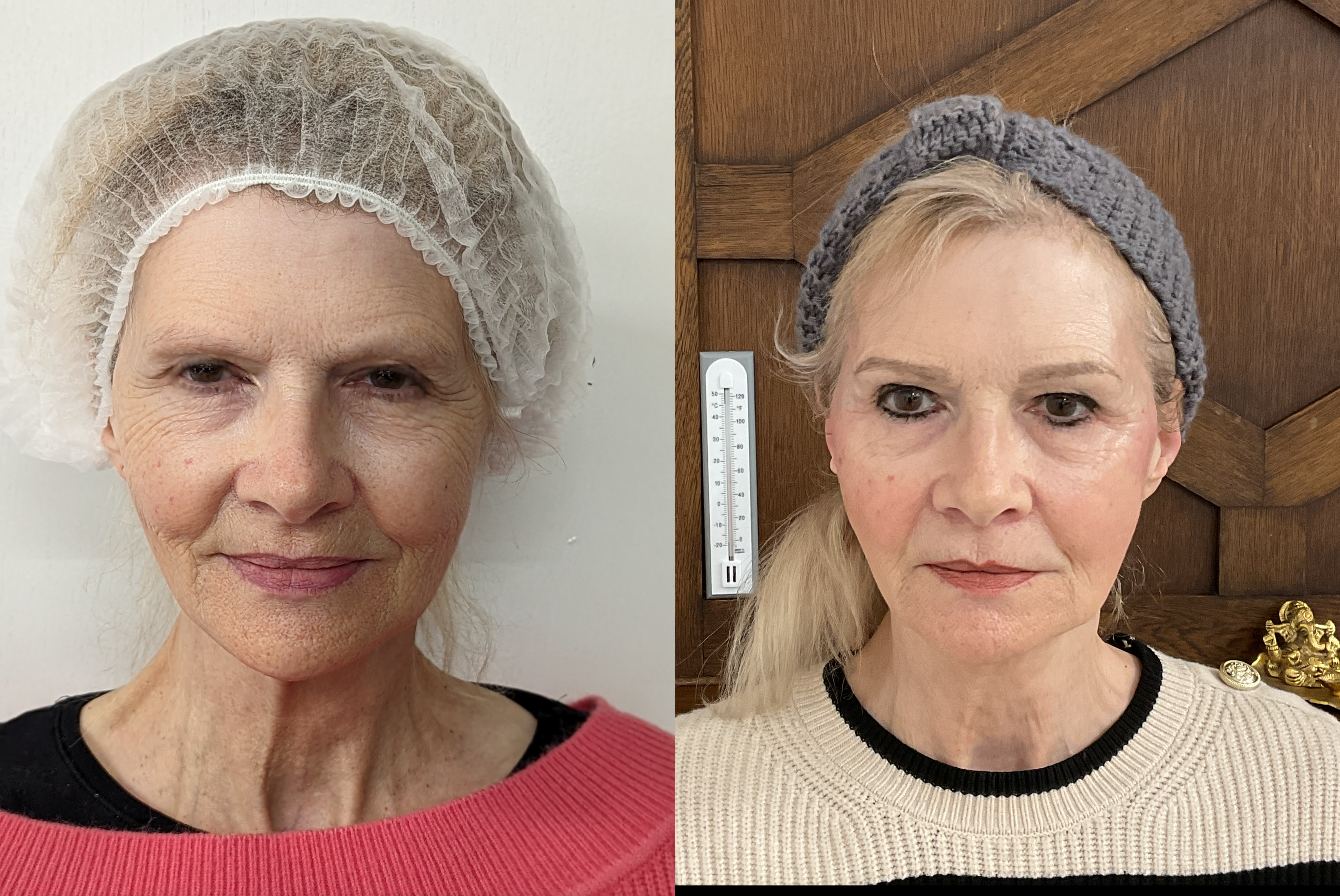 Thread lift result