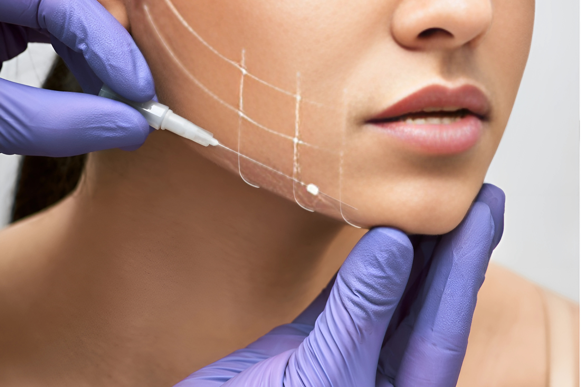 What Are Threads And Thread Lift Treatment